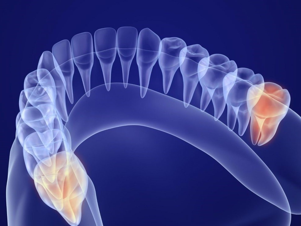 親知らずは必ず抜くものではないため、歯科医師と相談しながら判断することが大切です