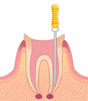 抜歯を避ける丁寧な根管治療
