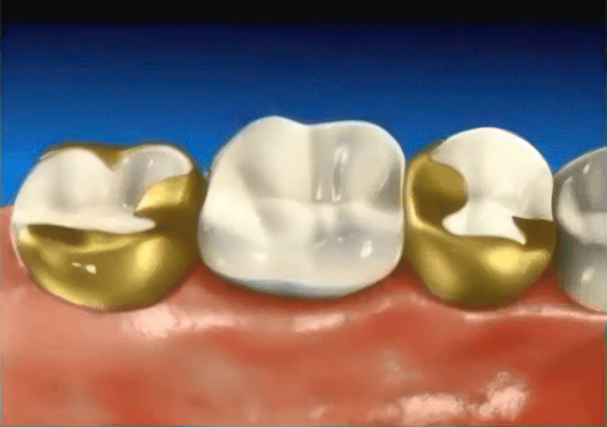 ヒューマンブリッジの装着イメージ