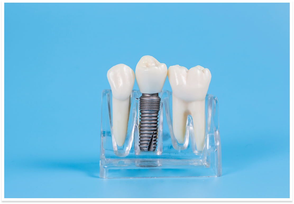 CT完備で安心インプラント治療