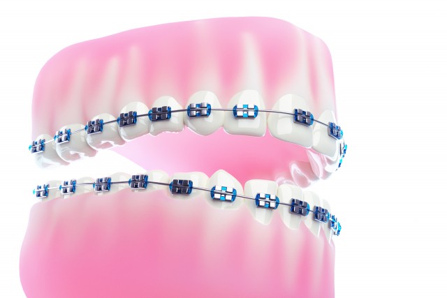 ブラケットとワイヤーを用いて計画的に歯を動かし、複雑な歯列不正や噛み合わせのずれにも対応しています。※写真はイメージです。