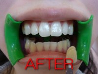 希望する方には定期的なタッチアップ（再ホワイトニング）も提案しています