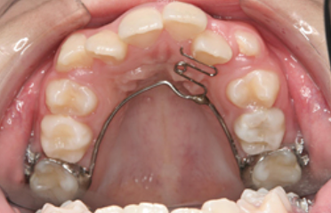 逆被蓋や噛み合わせにお悩みの方は、固定式リンガルアーチ矯正を検討することで、快適な生活と美しい歯並びを手に入れることができます。