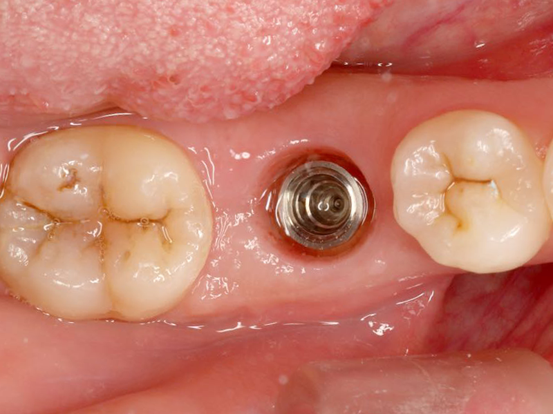 精密な診断で安心のインプラント