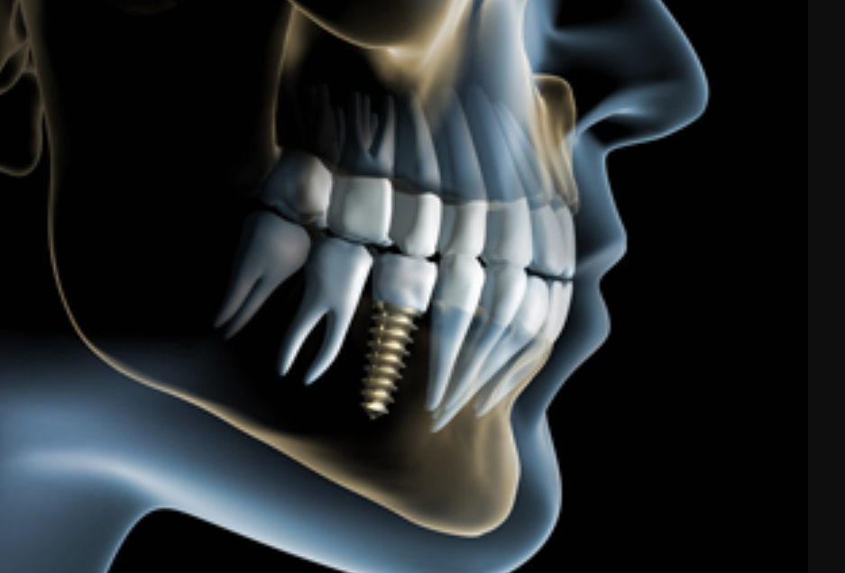 精密な診断と確かな技術で、安全なインプラント治療を提供します