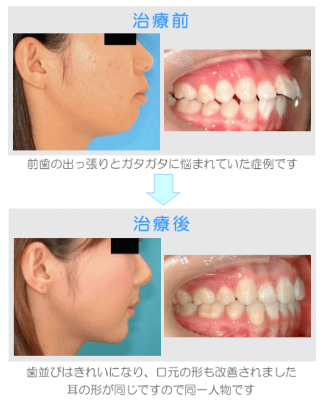 2年6ヶ月かけて矯正した治療例です