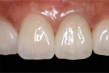 セラミックによる治療例