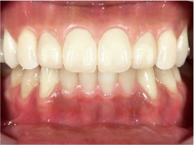 オールセラミックスを使用した治療例です