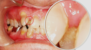 歯茎の腫れや出血は早めの治療を