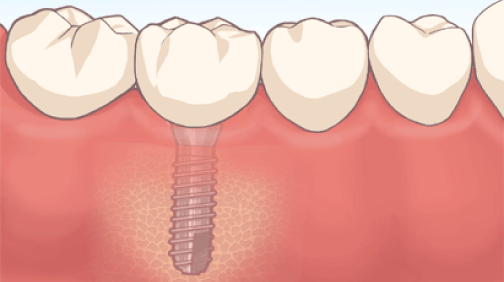 インプラント治療で自然な噛み心地と見た目を取り戻せます。