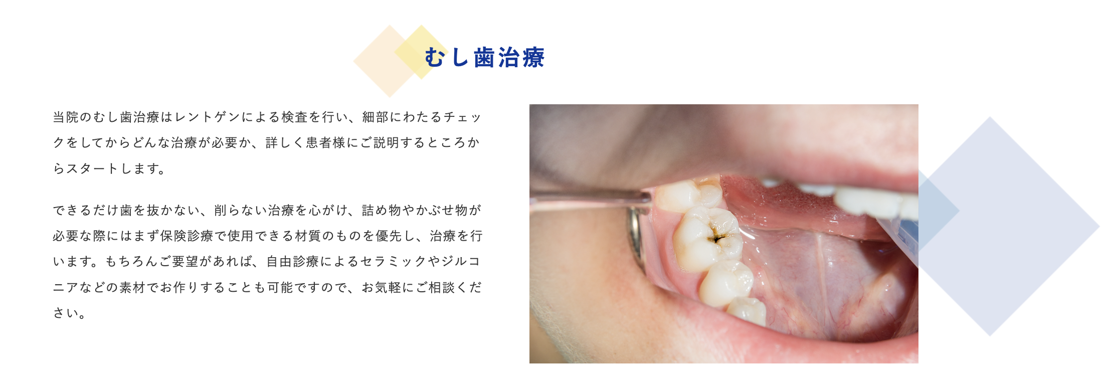 むし歯や進行したむし歯に伴う根管治療など、幅広い治療に対応しています