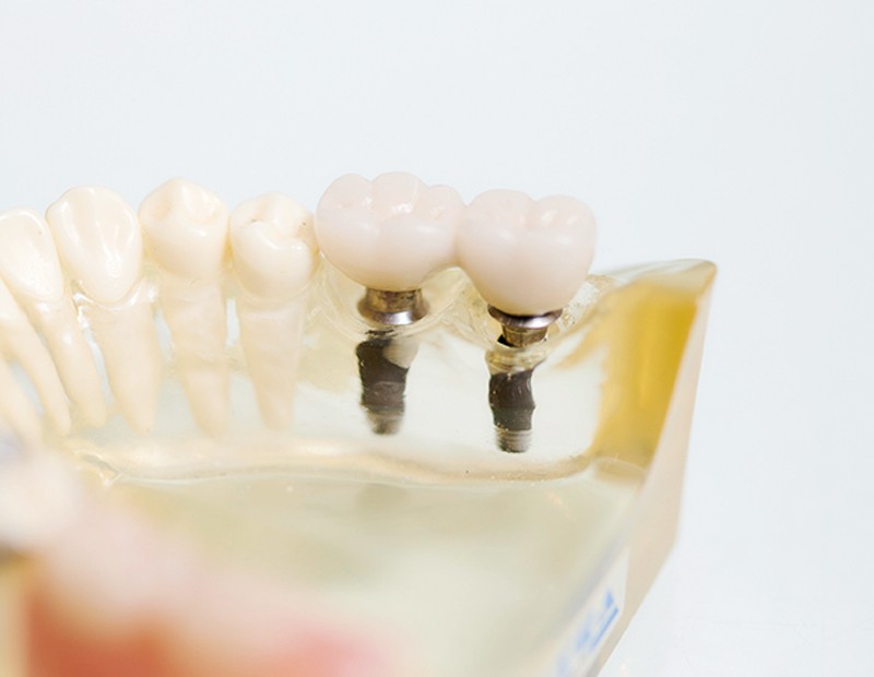 最大の魅力は、天然歯と遜色ない噛み心地と、自然な見た目を回復できる点にあります