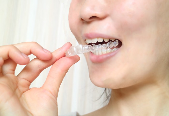 マウスガードは怪我防止に役立ちます