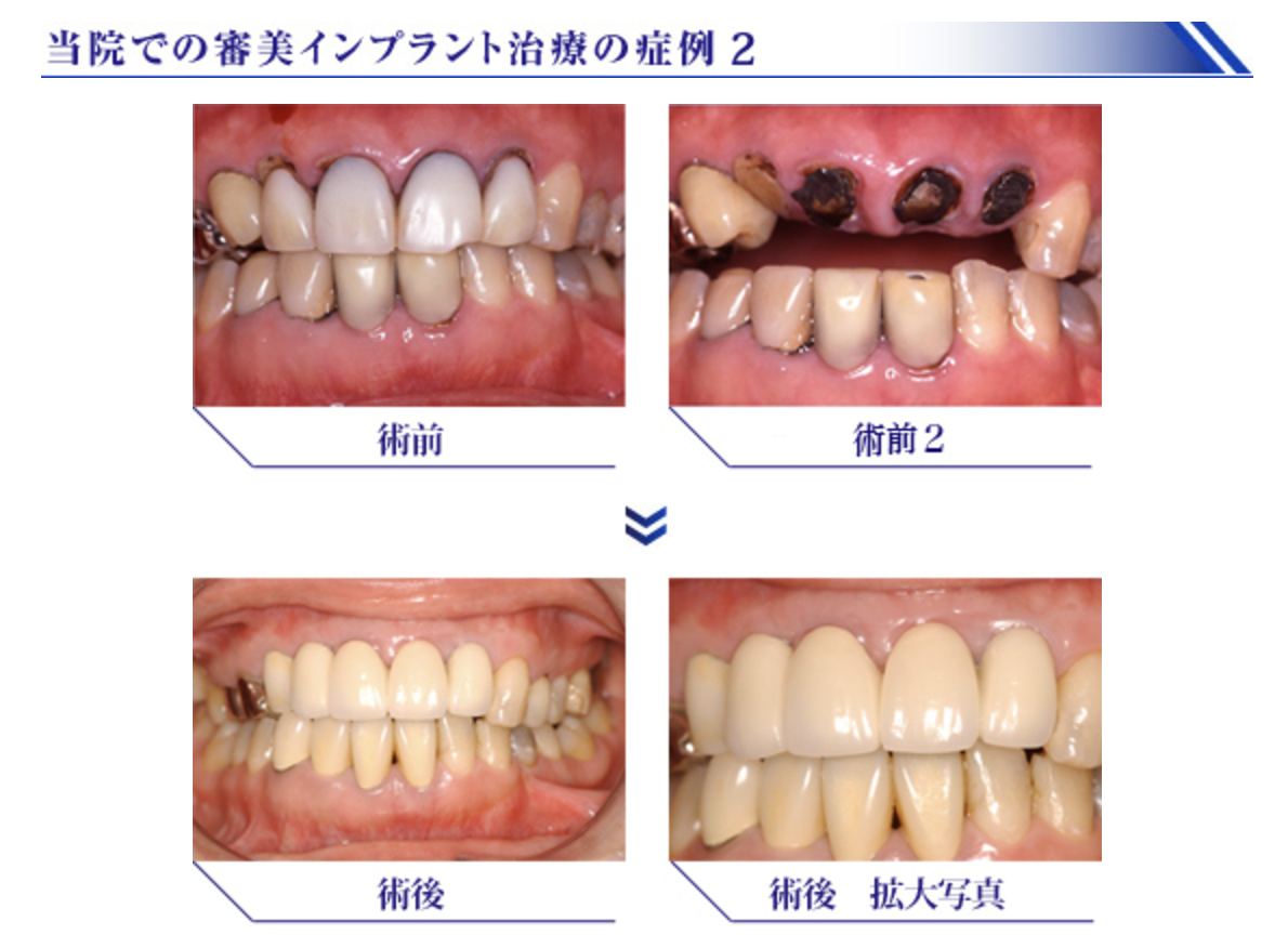 インプラントを用いた審美歯科治療を行っています
