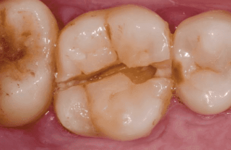 歯の負担を軽減しましょう