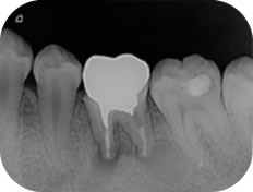 治療した歯の繰り返す痛みや不快な症状があったらお早めにご相談ください