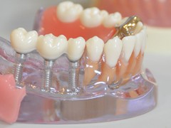【インプラント治療】CTを用いた立体診断と完全個室オペ室！本物の歯のような噛み心地を取り戻す