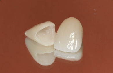 銀歯が気になる方もご相談ください