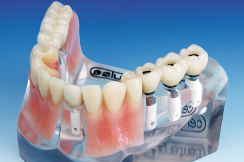 インプラントの入ったお口のイメージ図
