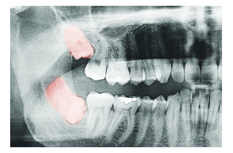 これまでに1000本以上の親知らずを抜歯した実績があり、多くの患者様に信頼されています