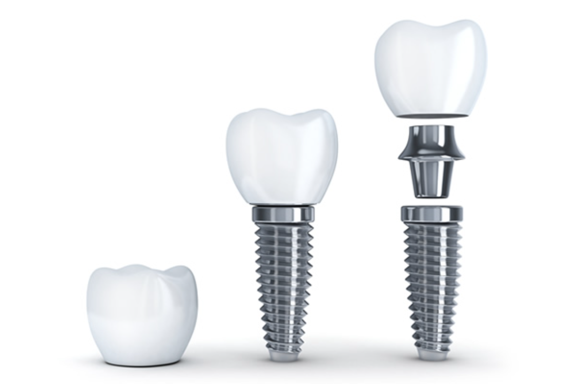 精密な診断と熟練の技術で、快適な口腔機能を回復します
