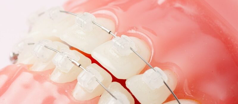 マウスピース矯正や部分矯正にも対応しています。