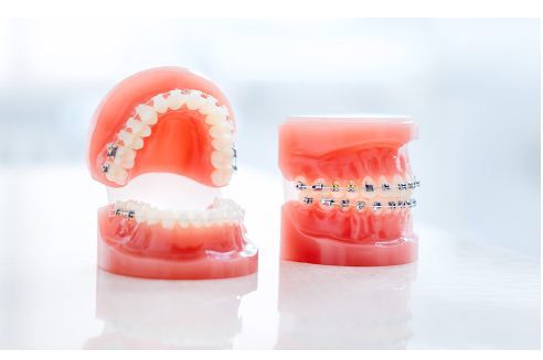 使用する矯正装置の例