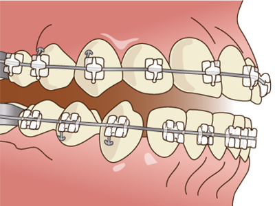 見た目だけじゃない、「噛む力」まで考えた矯正治療を