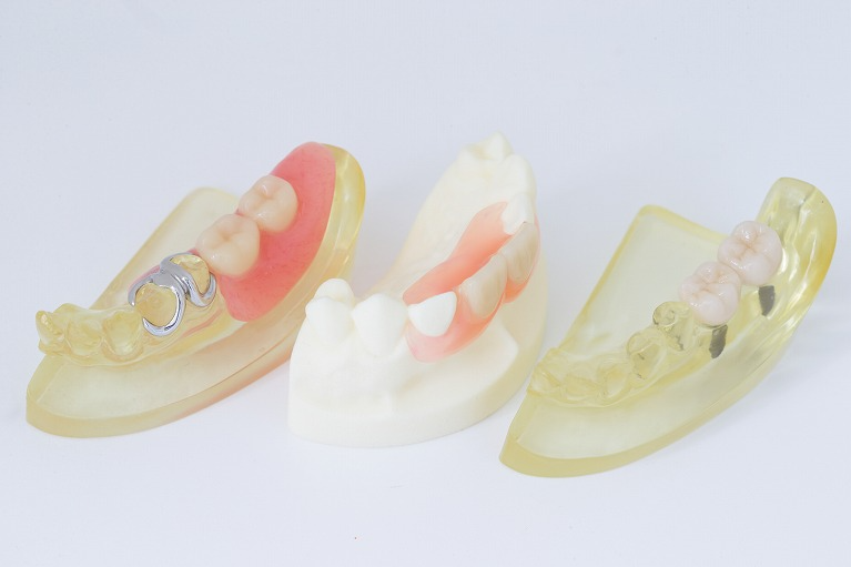 様々な種類の入れ歯があります