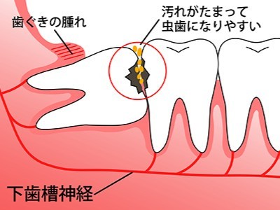 雑菌が侵入して炎症を起こすことで腫れや痛みが現れます