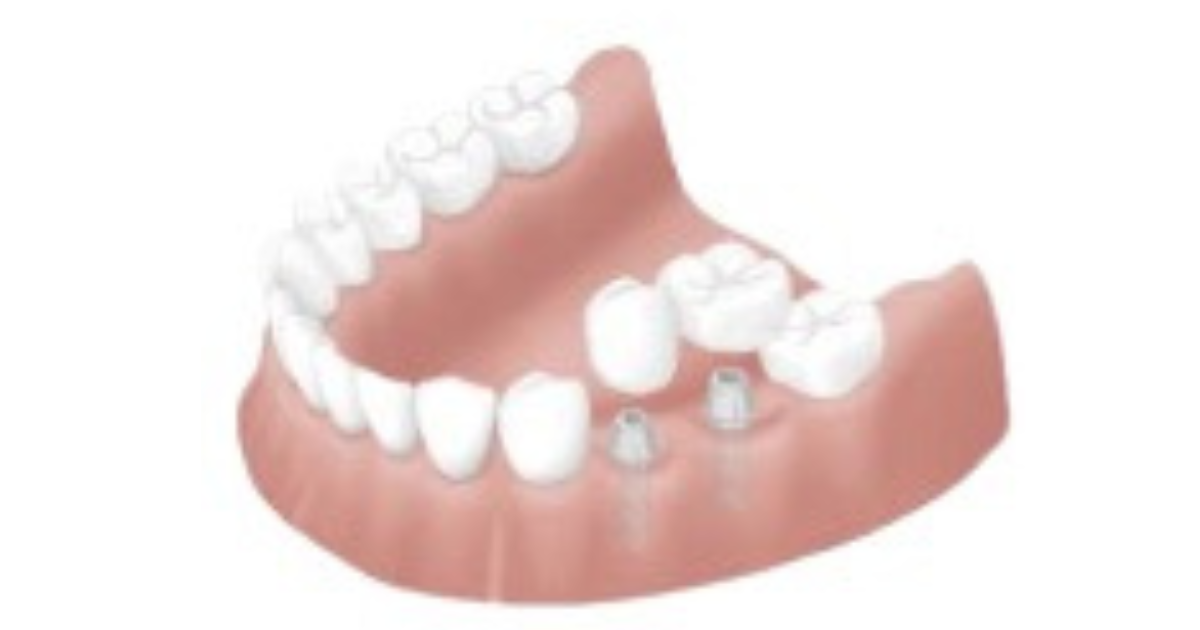 安全安心のインプラント治療