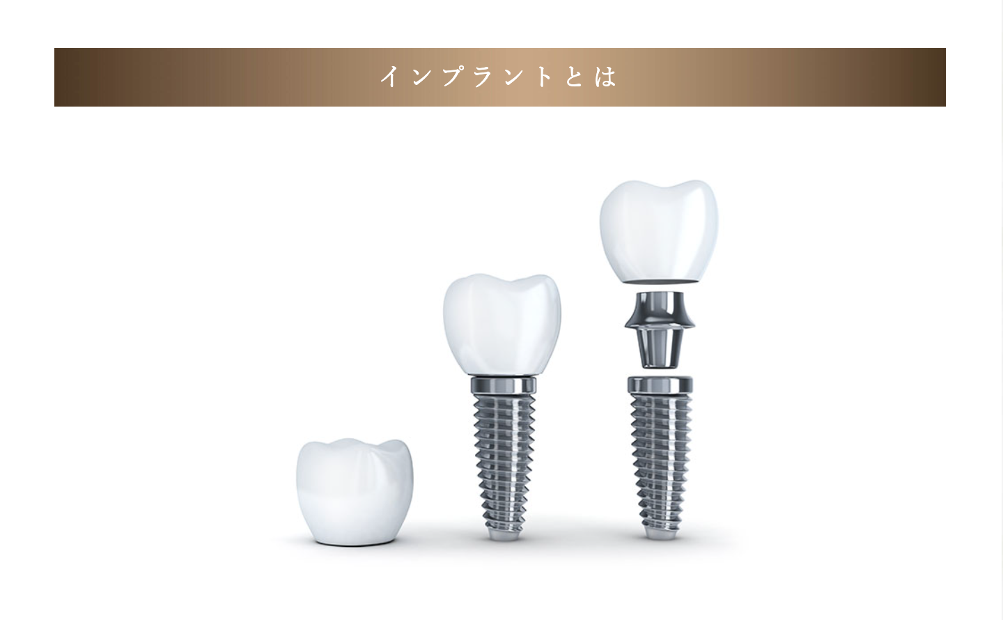 定期的なメンテナンスやアフターケアも行い、患者様の口腔内の健康をサポートいたします