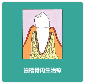 GTR法やエムドゲイン法で歯槽骨の回復を促進