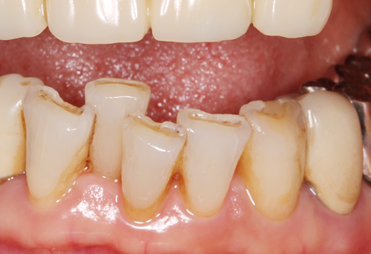 咬み合わせ治療を行うことで再発のリスクを下げて根本治療を行います。