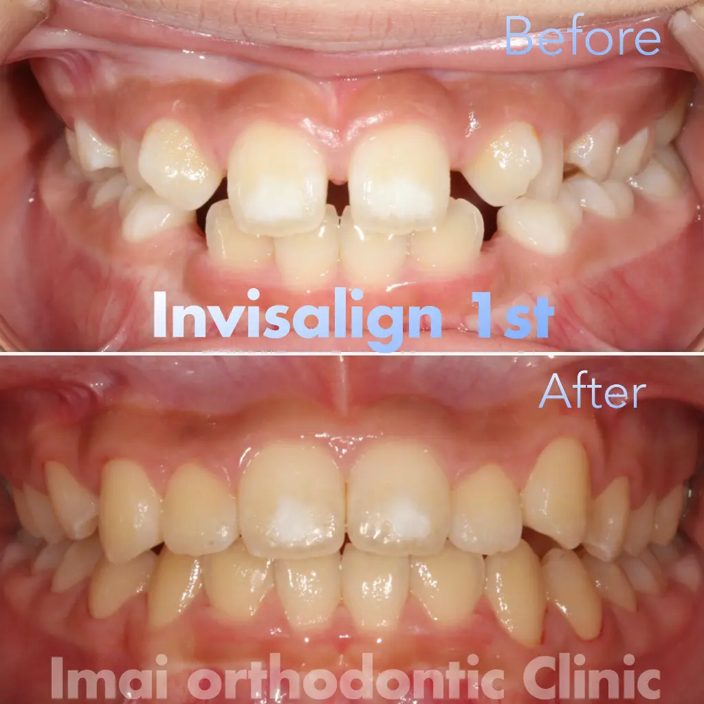 大人の矯正には主にマウスピース矯正と、ワイヤー矯正を用います