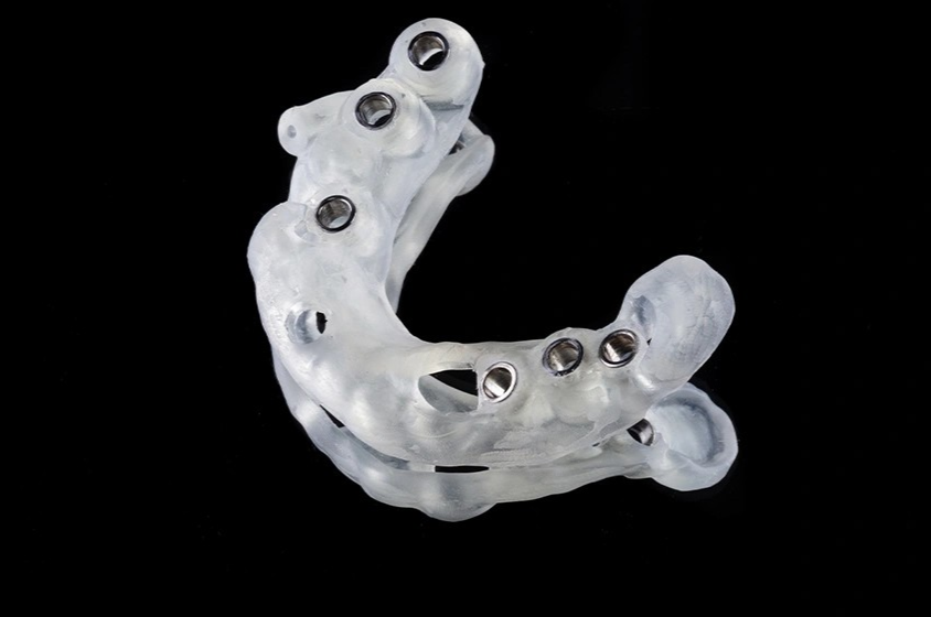 インプラント治療で笑顔を素敵に