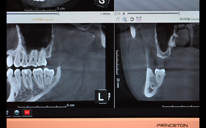 親知らず抜歯前のCT画像