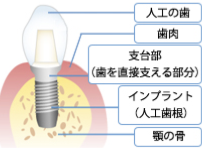 インプラントのメリットを生かした治療を提供します