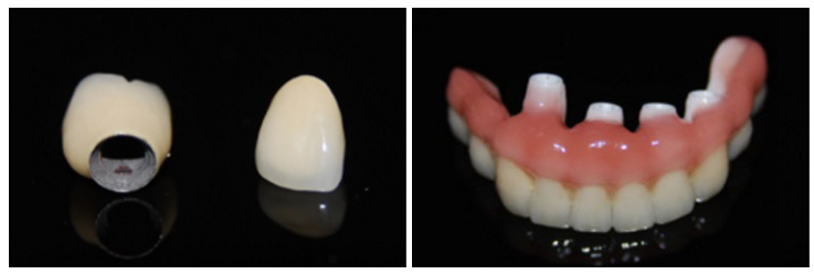 インプラントの見本