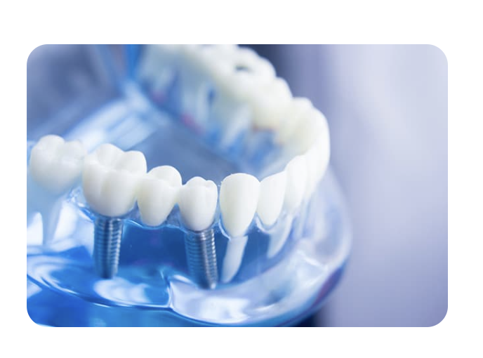 歯を失った部分に人工歯根を埋め込み、自然な見た目とかみ合わせを再現する治療法です