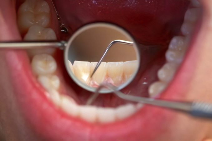歯科医院の定期検診やクリーニングを利用しましょう