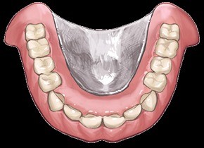 装着後も快適に使用できるよう調整やメンテナンスを継続し、長期的な口腔機能の維持を支援しています。
