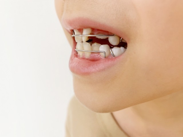 噛む、話すといった口腔機能の発達や、全身の成長との調和を考慮しながら進める治療です。※写真はイメージです