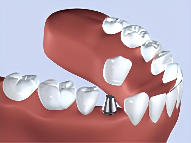 自分の歯のように噛める新しい治療法