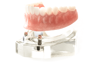 入れ歯を使用したインプラント治療