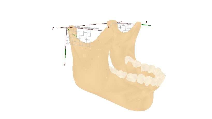 適切な咬合ができるアゴの位置を診断した図