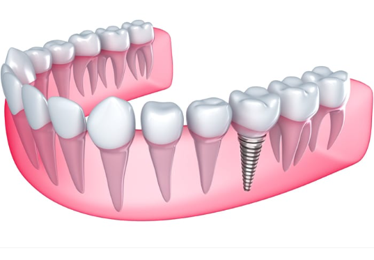 インプラントのモデル図