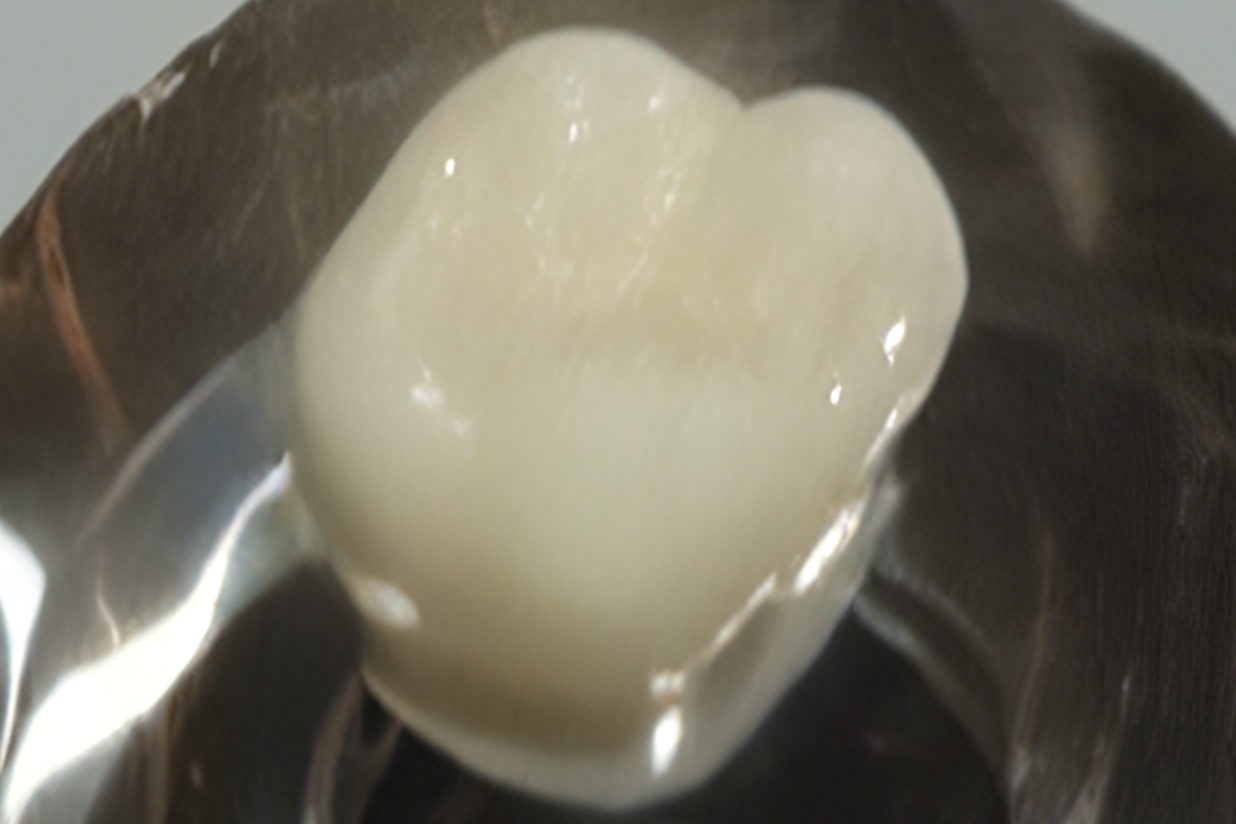 セラミックで作られた修復物