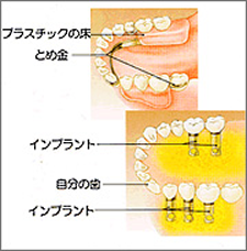 インプラントと入れ歯やブリッジとの違いについて