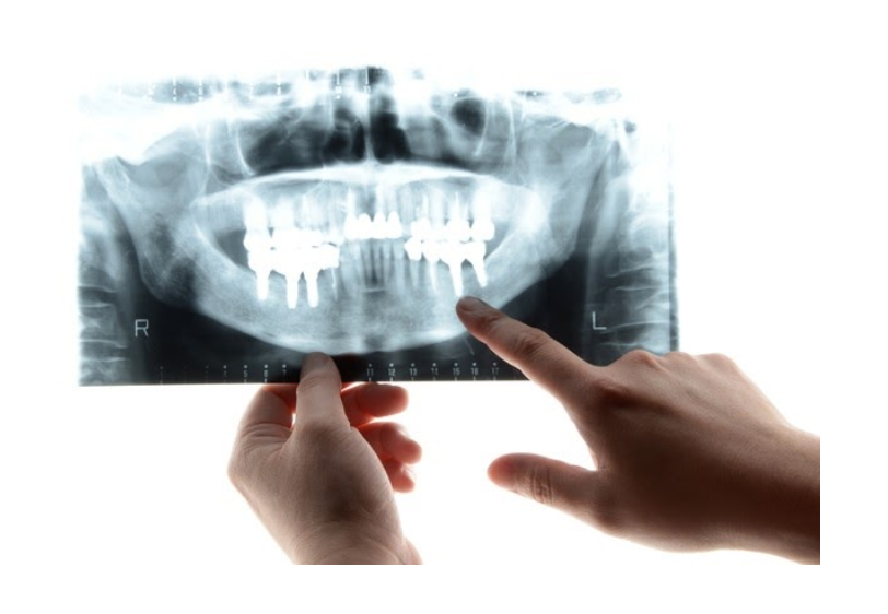 日本口腔インプラント学会専門医が診査・診断を行い、患者様の口腔状態に適した治療計画を立てます